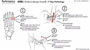 Orthosis Design Exam / First Ray Pathology