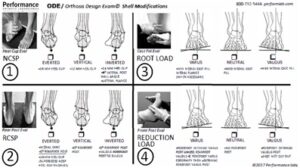 Orthosis Design Exam / Shell Modifications